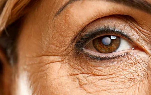 O incrível evolução no tratamento da Catarata