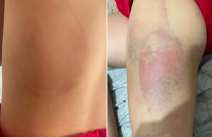Menina de 7 anos é agredida e ameaçada pelo pai se ela contasse sobre os hematomas à mãe