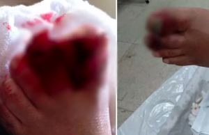 Idoso tetraplégico tem dedos esmagados por elevador de ônibus em Santos, SP