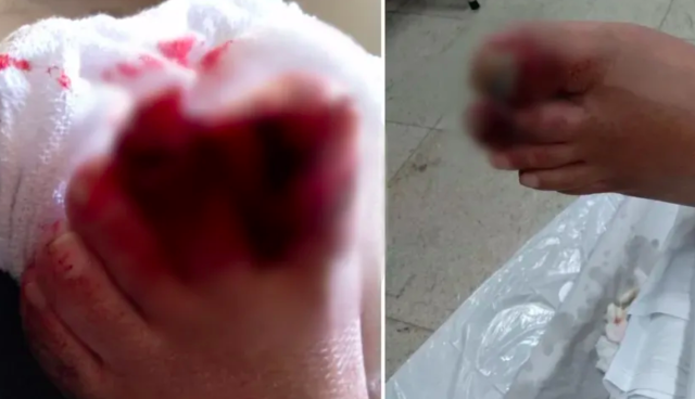 Idoso tem o pé esmagado em elevador de ônibus