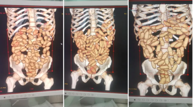 tráfico internacional de drogas (mulas)