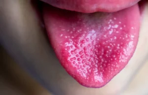 Surtos de doença que deixa manchas na pele e língua ‘framboesa’ afetam crianças; saiba o que é a escarlatina