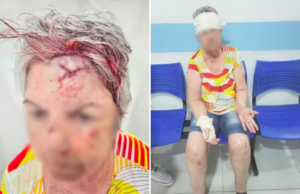 Idosa de 72 anos é atacada por criminoso e leva seis pontos na testa após cair no chão