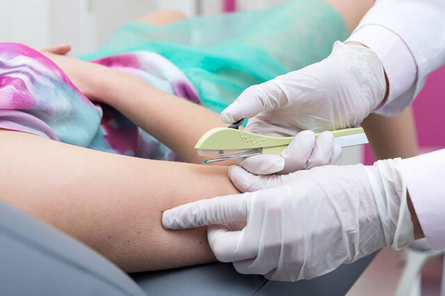 Implanon anticoncepcional aplicação