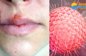 “Herpes” conheça os sintomas e prevenções contra o vírus