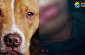 Pitbull ataca criança e arranca parte do lábio dela
