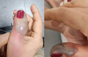 Idosa de 66 anos tem infecção grave após fazer unha na manicure em (GO)